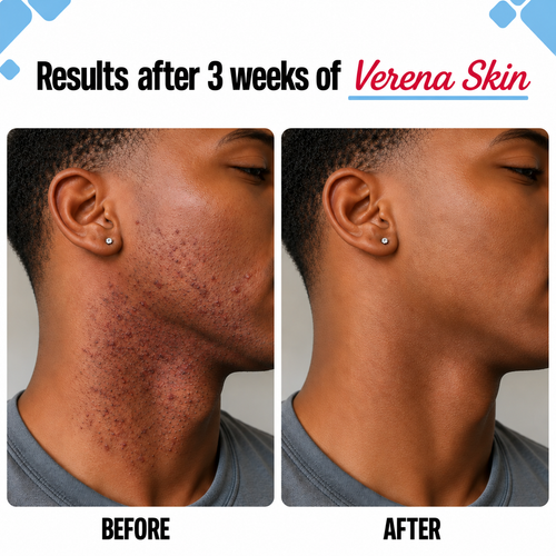 Verena Skin Bump Smoothing & Relief Solution