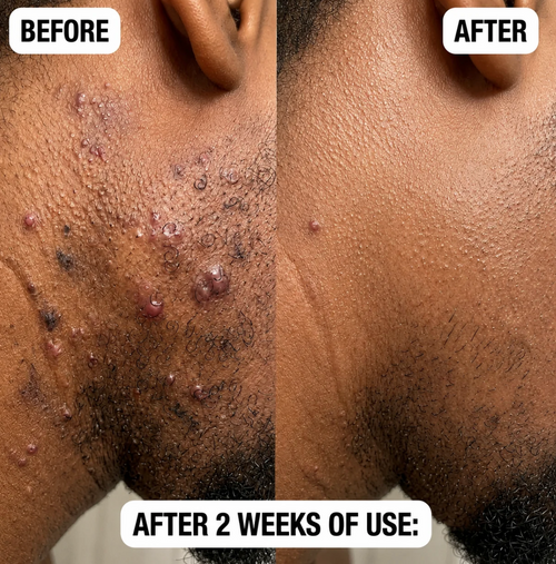 Verena Skin Bump Smoothing & Relief Solution